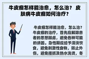 牛皮癣怎样能治愈，怎么治？ 皮肤病牛皮癣如何治疗？