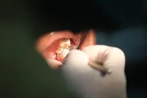 告别牙龈萎缩，重拾自信微笑！