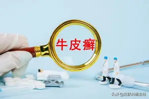 银屑病怎么办？ 牛皮癣怎么办？