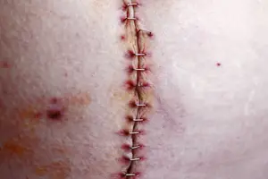 绽放美肌,尝试光子嫩肤 绽放美肌,尝试光子嫩肤