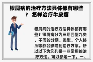 银屑病的治疗方法具体都有哪些？ 怎样治疗牛皮癣