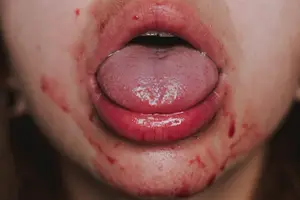 预防脑出血后遗症,保护健康! 预防脑出血后遗症,保护健康!