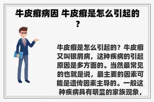 牛皮癣病因 牛皮癣是怎么引起的？